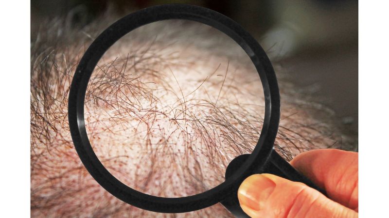 أسباب تساقط الشعر عند النساء